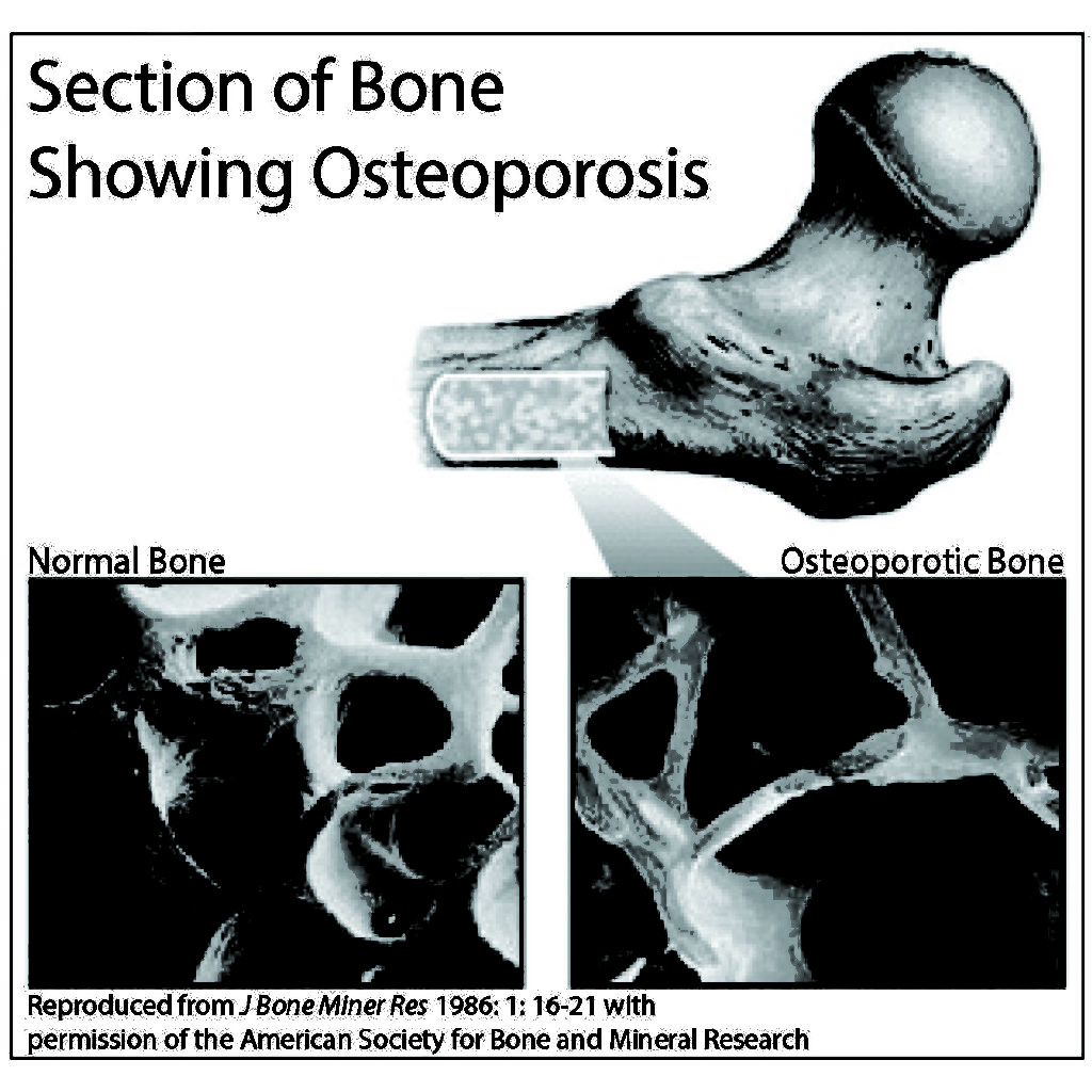 Section of Bone Showing Osteoporosis