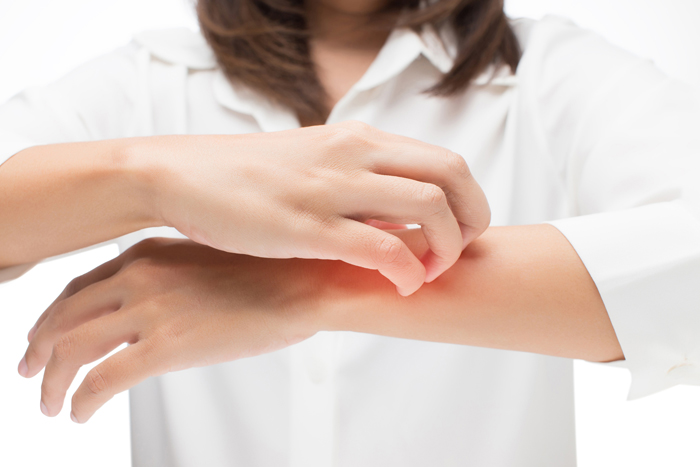 Image of woman with red, itchy arm